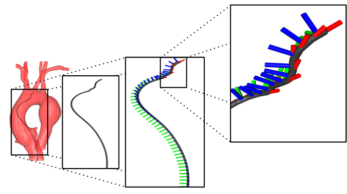 Low Tort Aorta